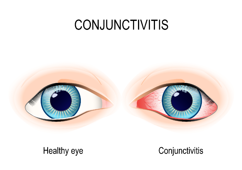 Conjonctivite